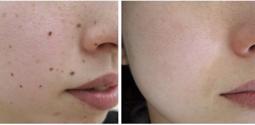 Acne scarring